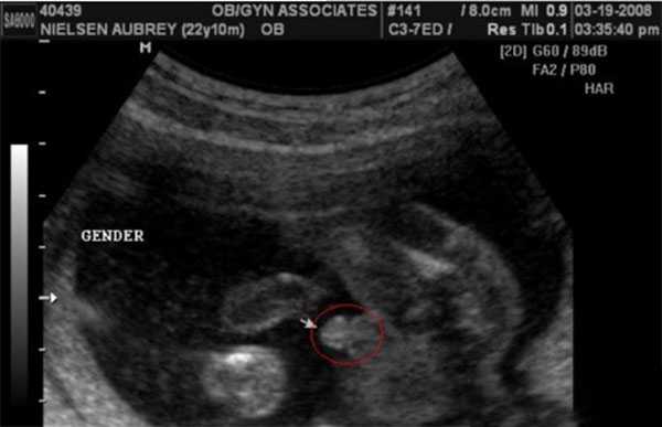 怀孕3个月图解B超看胎儿性别，怀男孩小鸡b超单原来长这样