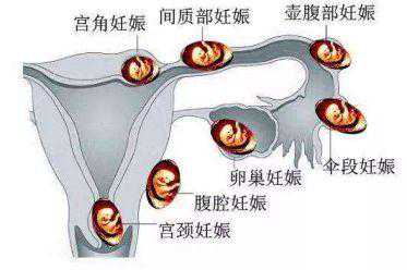 云南代孕机构官网网站_hcg值可以鉴别宫外孕吗？为什么？