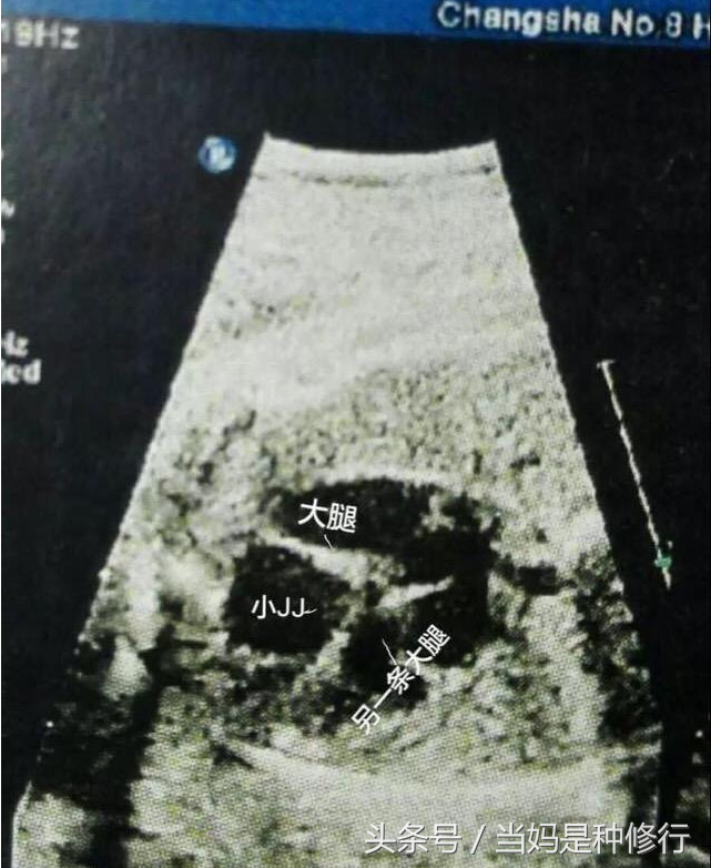 郑州代孕那儿最权威_B超图像已经显示男宝，附这次症状