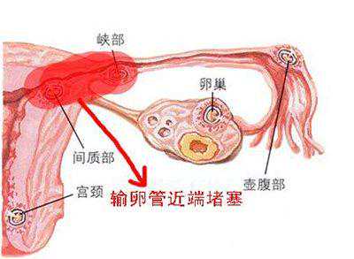 代孕小孩如何入户_输卵管不通，该咋办？还能怀孕吗？